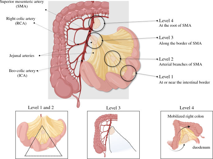 ksoreide's tweet image. Coming soon 👉 Surgery for SB-NET in @AnnSurgOncol together with 🤩🎓 @HalletJulie @SStattner @Neuroendocrine @MdtSome4 @hpb_so @me4_so 
#NeuroendocrineTumors #SurgOnc #CancerSurgery
