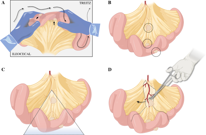 ksoreide's tweet image. Coming soon 👉 Surgery for SB-NET in @AnnSurgOncol together with 🤩🎓 @HalletJulie @SStattner @Neuroendocrine @MdtSome4 @hpb_so @me4_so 
#NeuroendocrineTumors #SurgOnc #CancerSurgery