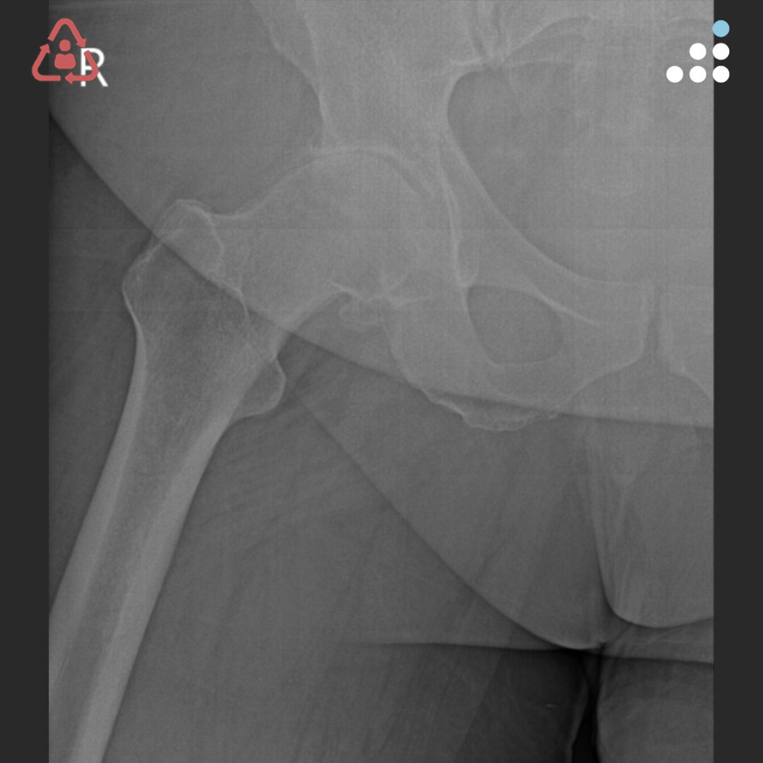 orthobullets's tweet photo. Here is a new case by Dr. Jonathan @Yerasimides  and Louisville Hip & Knee Institute.

HIP ARTHRITIS IN OBESE 56M WITH BMI OF 53

This case will be debated at the Anterior Hip Foundation (@AAHips) 2024 Innovation Symposium in Nashville, Tennessee, May 17-18, 2024

How would you manage this #orthotwitter?

Vote on this case for CME: https://t.co/iAxKsqXh4E
