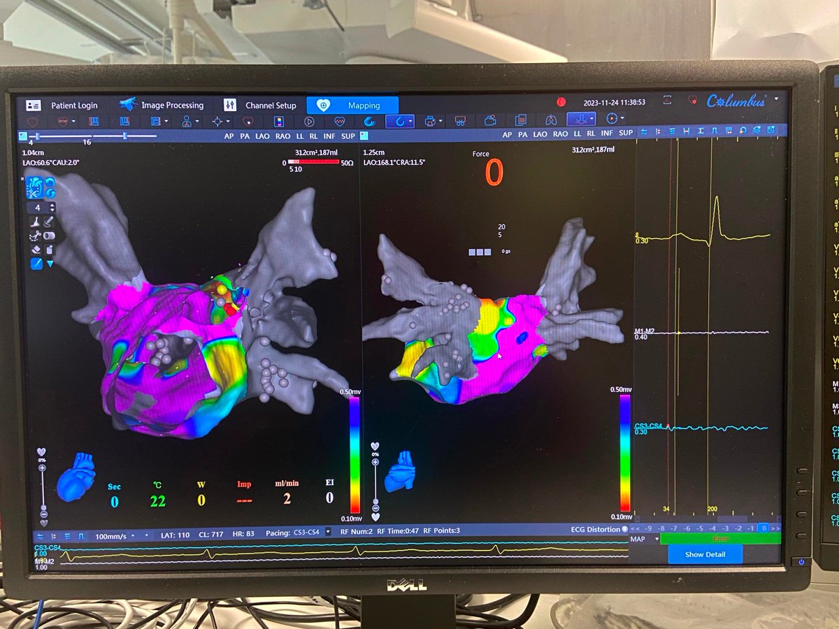 First experience with version 4.2 of the Everpace Columbus Mapping system in Europe.  Significant step forward, ready for contact sensing catheters and prepared even for PFA integration.