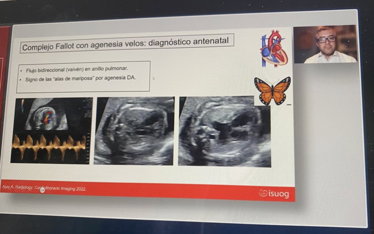 <a href="/ISUOG/">ISUOG</a> Importancia de la correcta evaluación de los tractos de salida del corazón para la detección de anomalías conotruncales #Fallot #TGA #VDDS 
<a href="/ISUOG/">ISUOG</a>