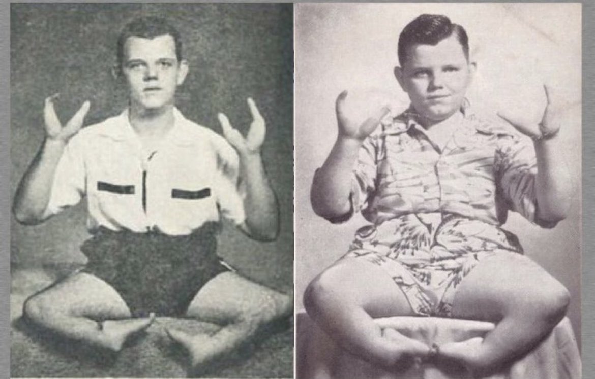 Grady Franklin Stiles Jr. was an American freak show performer and murderer. His deformity was the genetic condition ectrodactyly, in which the fingers and toes are fused together to form claw-like extremities. Because of this, Stiles performed under the stage name 'Lobster