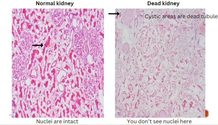 Janiranavarro's tweet photo. Transplant frozen-kidney🥶
Dead kidney can mimic normal kidney
-Go high power and check if there are nuclei present
-If multiple cystic areas present-dead tubules
Dr. Hassler #CAP23 #frozensections #transplantpath #surgpath #PathX #PathTwitter #pathology #pathologists https://t.co/loi81POKwf
