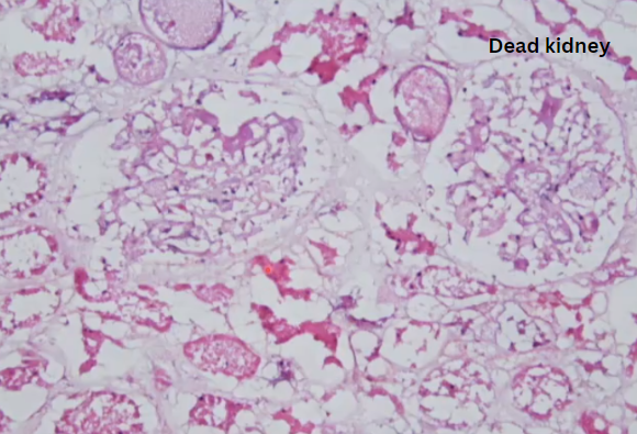 Janiranavarro's tweet photo. Transplant frozen-kidney🥶
Dead kidney can mimic normal kidney
-Go high power and check if there are nuclei present
-If multiple cystic areas present-dead tubules
Dr. Hassler #CAP23 #frozensections #transplantpath #surgpath #PathX #PathTwitter #pathology #pathologists https://t.co/loi81POKwf