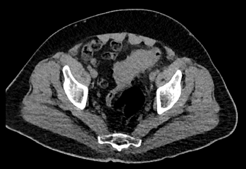 Rad_Bits's tweet photo. Quiz245: Tough case 💪, thoughts?

A randomly selected winner will get a prize 🏆 🎁 
#meded #raded #radiology #mededucation #foamrad #foamed #radres