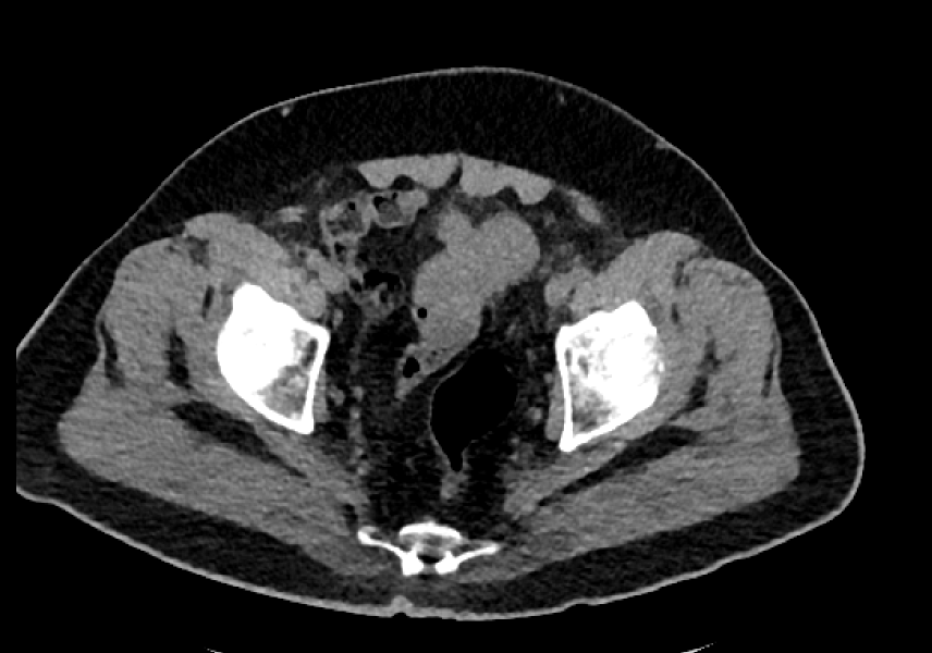 Rad_Bits's tweet photo. Quiz245: Tough case 💪, thoughts?

A randomly selected winner will get a prize 🏆 🎁 
#meded #raded #radiology #mededucation #foamrad #foamed #radres