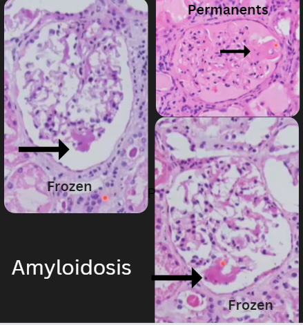 Janiranavarro's tweet photo. Transplant frozen-kidney🥶
How to sign frozen cases that look like amyloidosis?
-Eosinophilic material filling the basement membrane and the mesangium, of unknown significance
Dr. Hassler #CAP23 #frozensections #surgpath #PathX #PathTwitter #pathology #pathologists https://t.co/wr88sLzcXY