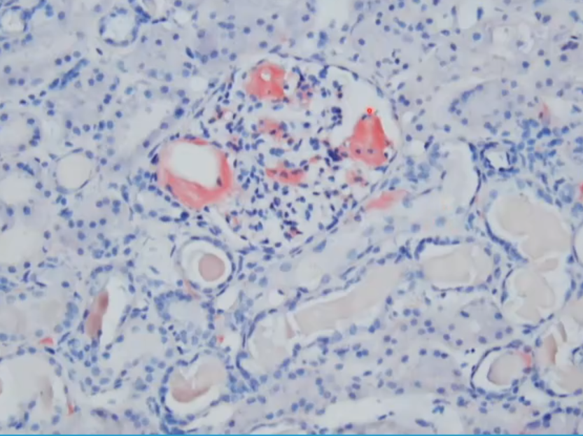 Janiranavarro's tweet photo. Congo red (left): Positive for amyloid, but negative for other deposition diseases
Crystal violet (right): It is positive in amyloid and other deposition diseases
Dr. Hassler #CAP23 #frozensections #renalpath #surgpath #PathX #PathTwitter #pathology #pathologists https://t.co/CN4pudnRLN