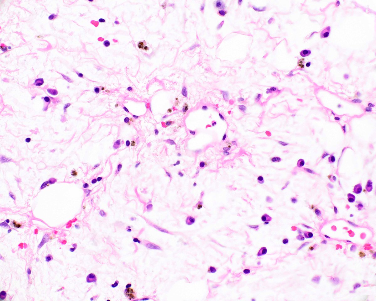 Perirenal myxoid pseudotumor of fat was first described in association with renal cell carcinomas.  Over time, we have learned that it is incidental.  The cells differ in appearance from those in liposarcomas (MDM2 testing can reassure).#UMiamiPath
PMIDs: 30826321. 19525929.