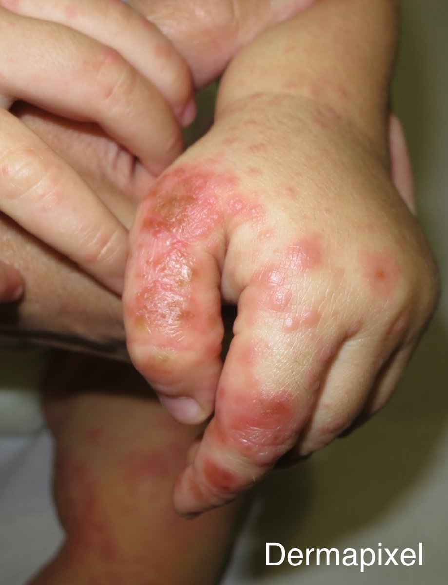 Rosa Taberner (@rosataberner) on Twitter photo Si es sábado, hay <a href="/dermapixel/">Dermapixel</a>. Y si se acerca el final del mes, entonces toca caso pediátrico. ¿Qué le pasa a Ainara?
dermapixel.com/2023/11/una-de…
#dermatology #dermatología #pediatría Si es sábado, hay <a href="/dermapixel/">Dermapixel</a>. Y si se acerca el final del mes, entonces toca caso pediátrico. ¿Qué le pasa a Ainara?
dermapixel.com/2023/11/una-de…
#dermatology #dermatología #pediatría