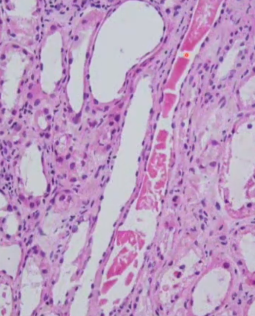 Janiranavarro's tweet photo. Transplant frozen-kidney🥶
Myeloma casts
-Cracked and fractured casts
Dr. Hassler #CAP23 #frozensections #transplantpath #surgpath #PathX #PathTwitter #pathology #pathologists https://t.co/DeWOHR0I0x