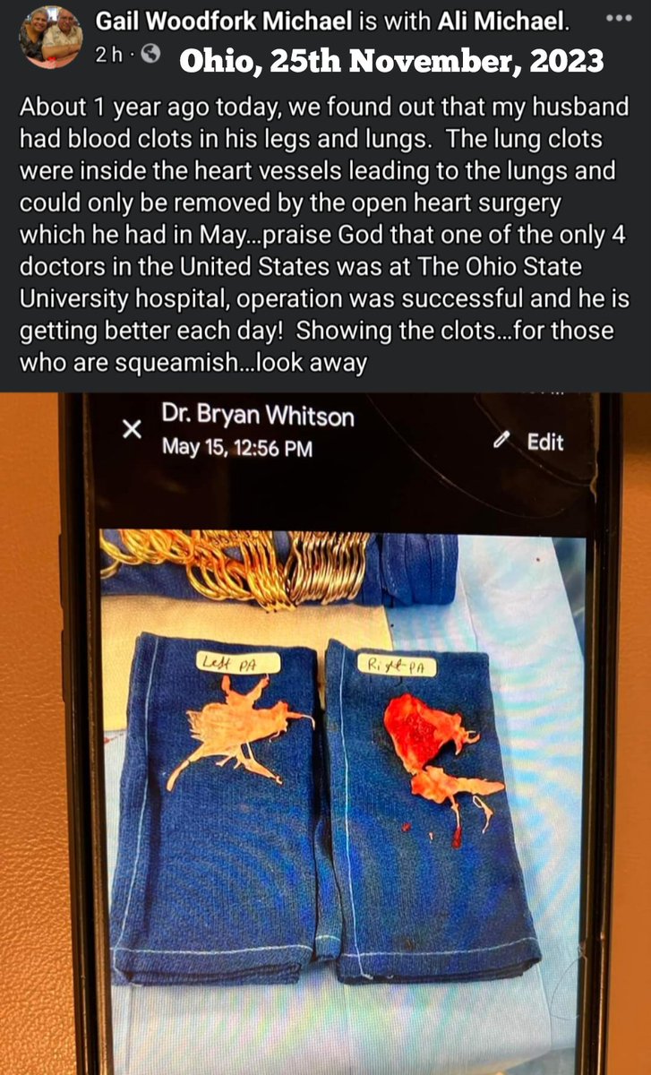tulloch1978's tweet photo. Ohio - Ali Michael.
Blood Clots @Pfizer
"About 1 year ago today, we found out that my husband had blood clots in his legs and lungs. The lung clots were inside the heart vessels leading to the lungs and could only be removed by the open heart surgery." https://t.co/6JybGBqs93
