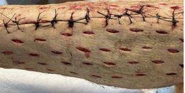 This holiday weekend, we remind you that our favorite kind of pie crust has nothing to do with dessert at all:  

Specifically, it is a technique that facilitates closure of fasciotomy wounds.

For details, see the article by @matthewkazadeh et al:
 
➡️ bit.ly/3SXfFlW