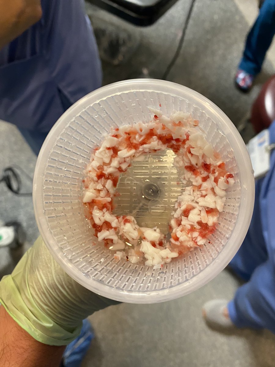 Johnny Su, MD (@johnnysumd) on Twitter photo Playing with our food this morning with <a href="/RRGonzalezMD/">Ricardo R Gonzalez MD</a>. Morcellating boiled eggs and 🍓!!! Our newest toy out of the many #BPH options offered at <a href="/HMethodistUro/">Houston Methodist Urology and Residency Program</a>. #GreenLEP #HoLEP Playing with our food this morning with <a href="/RRGonzalezMD/">Ricardo R Gonzalez MD</a>. Morcellating boiled eggs and 🍓!!! Our newest toy out of the many #BPH options offered at <a href="/HMethodistUro/">Houston Methodist Urology and Residency Program</a>. #GreenLEP #HoLEP