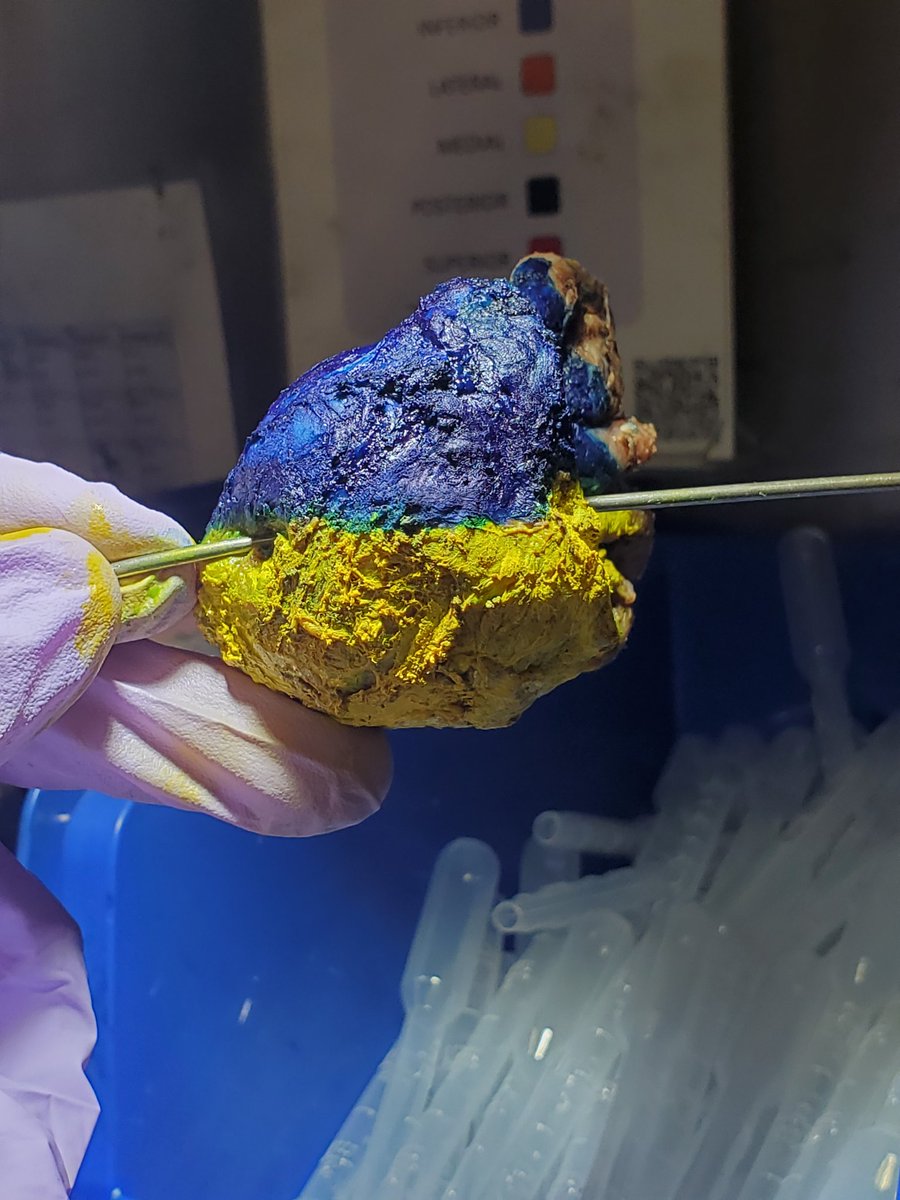 JacobRitter2's tweet photo. I inked this prostate in honor of Ukraine's independence day #pathology #Ukraine https://t.co/9pr7Ni2T4B