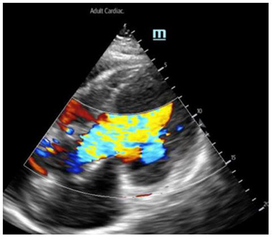 UTSW Emergency Medicine (@utsw_em) on Twitter photo Role of point of care ultrasound in detecting #AorticDissection with rare finding of diffuse alveolar hemorrhage; work from our <a href="/UTSW_EM/">UTSW Emergency Medicine</a> group by <a href="/JamesCaoMD/">James Dazhe Cao</a> <a href="/LynnRoppolo/">Lynn Roppolo</a> @JSinghDO <a href="/DevenBhatia/">Deven Bhatia</a> <a href="/jbrew452/">Jonathan</a> now in <a href="/jem_journal/">JEM_Journal</a>. #EmergencyMedicine
pubmed.ncbi.nlm.nih.gov/35931586/ Role of point of care ultrasound in detecting #AorticDissection with rare finding of diffuse alveolar hemorrhage; work from our <a href="/UTSW_EM/">UTSW Emergency Medicine</a> group by <a href="/JamesCaoMD/">James Dazhe Cao</a> <a href="/LynnRoppolo/">Lynn Roppolo</a> @JSinghDO <a href="/DevenBhatia/">Deven Bhatia</a> <a href="/jbrew452/">Jonathan</a> now in <a href="/jem_journal/">JEM_Journal</a>. #EmergencyMedicine
pubmed.ncbi.nlm.nih.gov/35931586/
