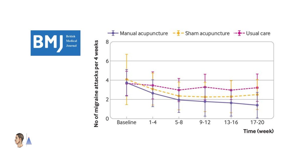 🔀Multicenter Randomized Controlled Trial🇨🇳
📰BMJ (IF 𝟯𝟬.𝟯)
Prophylaxis of episodic migraine without aura. Effectiveness of acupuncture 𝑣𝑠 sham acupuncture 𝑜𝑟 usual care. ↘ number of migraine days and frequency of migraine attacks. 

pubmed.ncbi.nlm.nih.gov/32213509/🔓