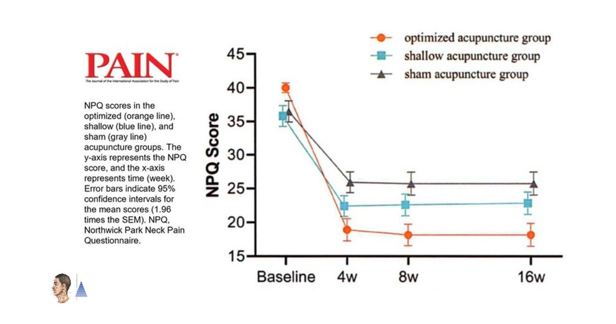 🔀Multicenter Randomized Controlled Trial🇨🇳
📰Pain (IF 𝟱.𝟰) 
Cervical spondylosis–related neck pain. Effectiveness of acupuncture [A] 𝑣𝑠 sham [A] 𝑜𝑟 superficial [A]. ↘ Northwick Park Neck Pain Questionnaire (NPQ), ↗ Quality of Life (SF-36).

pubmed.ncbi.nlm.nih.gov/32947547/