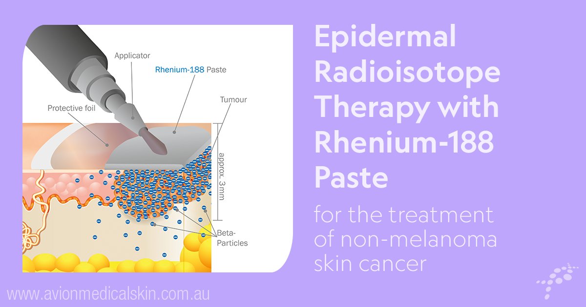 Rhenium-188 is a high energy beta-emitting radioisotope with a fairly short 17hr half-life.

Avion Medical Skin Centres is the specialist provider of this novel radioisotope therapy for non-melanoma skin cancer. Find out more here: avionmedicalskin.com.au