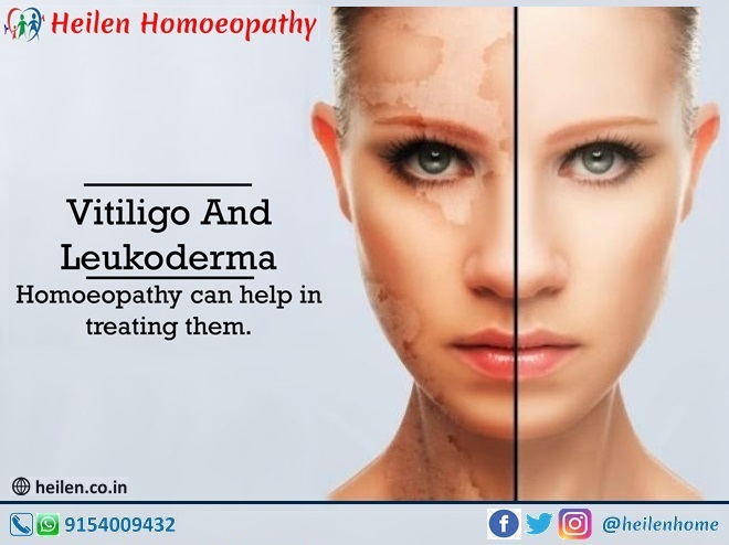 heilenhome's tweet photo. Vitiligo and Leukoderma are characterized by #whitespots or #whitepatches that appear in the body. Many people prefer #homoeopathy as it is natural and has no side effects.
#heilenhomoeopathy @heilenhome #vitiligo #leukoderma https://t.co/a763LxGzks