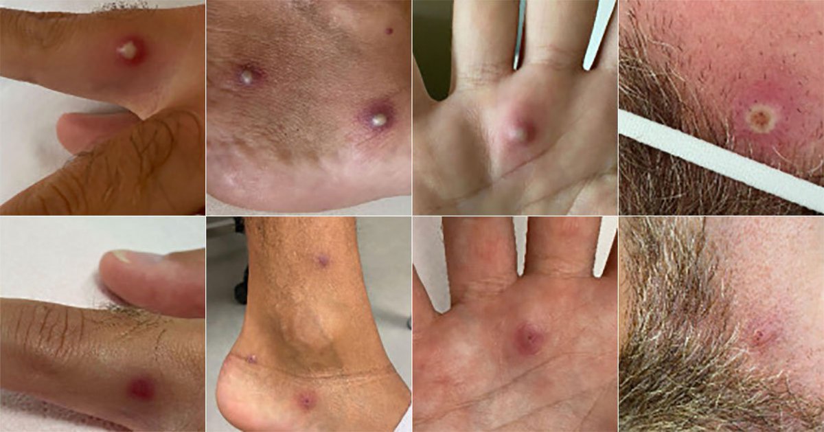 MothershipSG's tweet photo. Italian man, 36, tests positive for Covid-19, monkeypox &amp; HIV after Spain trip https://t.co/6HkCaZvgRO https://t.co/nC4p8ykW94