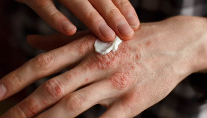 InfoResdung's tweet photo. Ketahui Makanan Untuk Mengelak Simptom Psoriasis

https://t.co/XD7ZpG4X7n

#biovco https://t.co/DB8sJ08reU