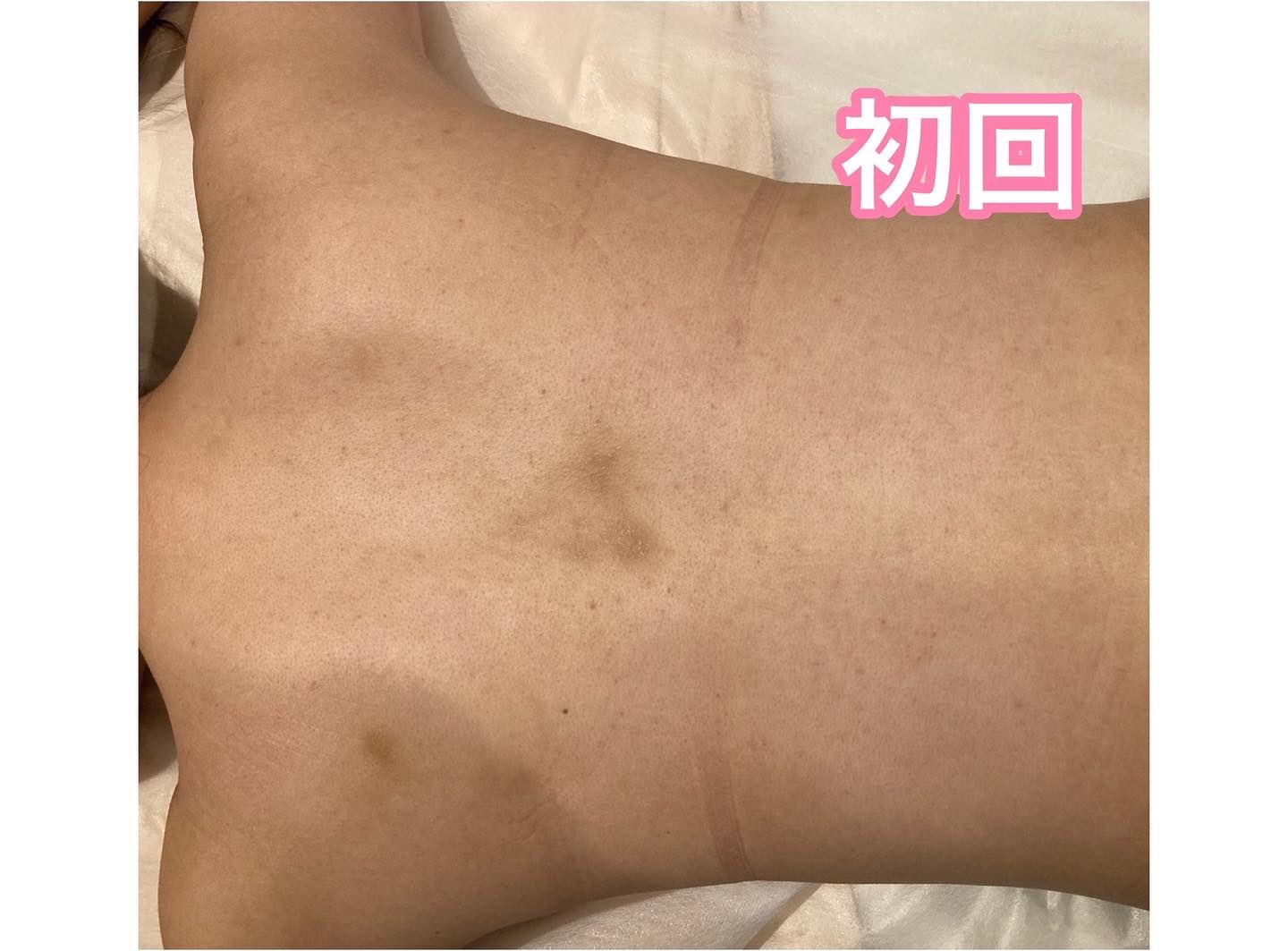 ☆お尻の黒ずみに有効成分5種のヒト幹細胞☆ 美尻研究所 美尻セラム ...