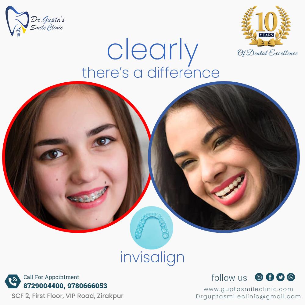 There is a lot of difference in Metal, Ceramic or Aligners. Choose wisely... #alignersmiles #Aligners #invisiblebraces #braces #smile #metalbraces #ceramicbraces #orthodontics #dentaltreatmentinindia #dentist #viproadzirakur #bestdentalclinic