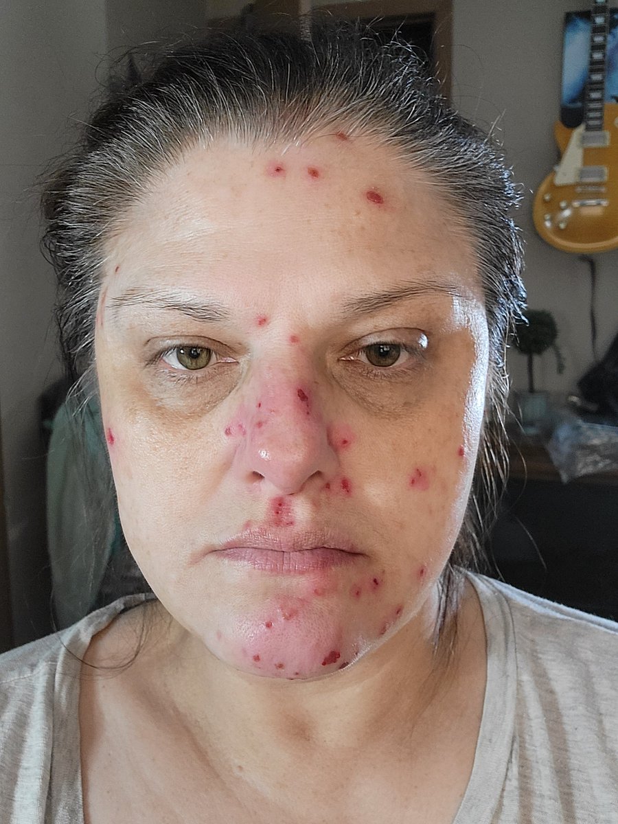 catparkerphoto's tweet image. Normally mortified by showing my face like this, however one of the many side effects of the #Pfizer jab, I will. I have NEVER had this happen to me before. My immune system is losing it! What was in it??! Why did they do this to us??!😭#vaccineinjured #canwetalkaboutit #medical