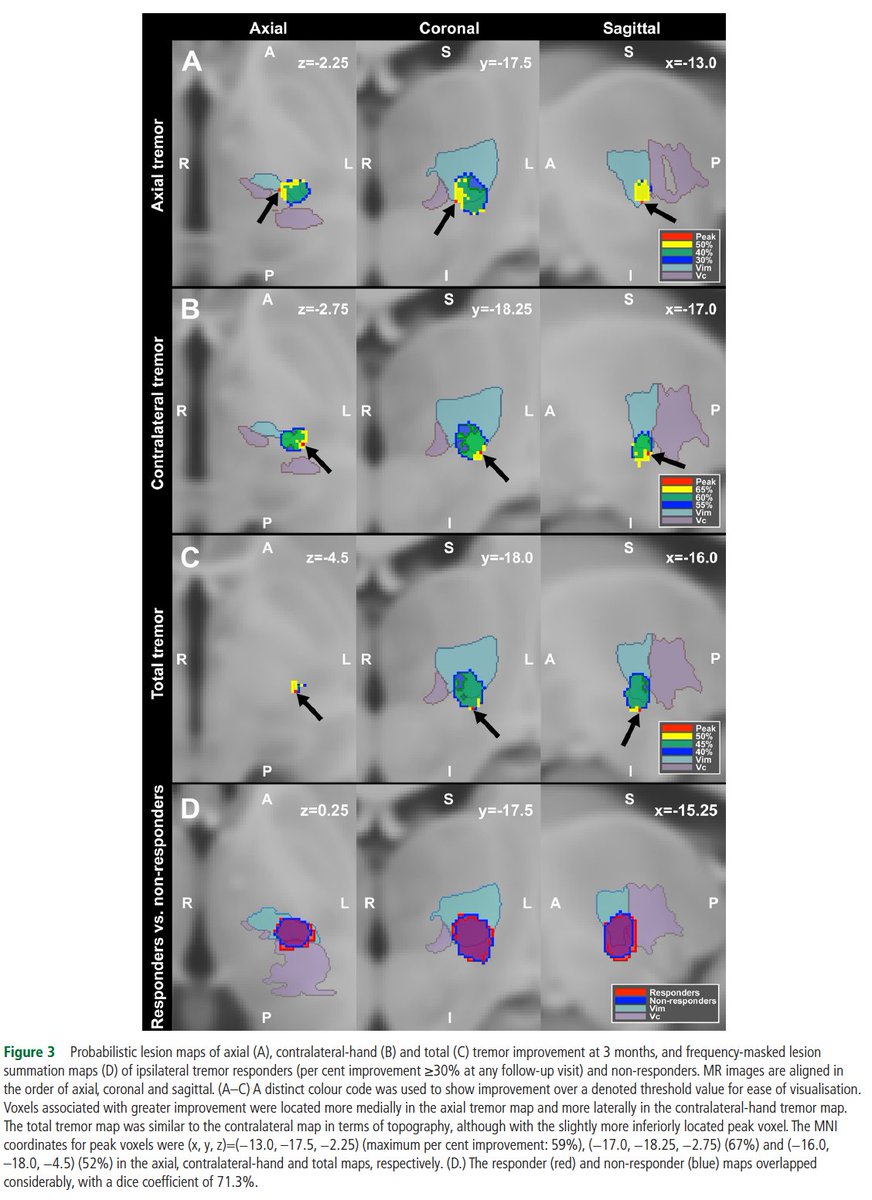 Alfonso Fasano (@dralfonsofasano) on Twitter photo #MRgFUS #thalamotomy is typically performed unilaterally for the #tremor of the dominant side. Patients often ask if their head/voice and non-dominant hand will also improve.
We looked into this and found that it happens in a subset with a slightly different targeting.
<a href="/JNNP_BMJ/">Journal of Neurology, Neurosurgery and Psychiatry</a> #MRgFUS #thalamotomy is typically performed unilaterally for the #tremor of the dominant side. Patients often ask if their head/voice and non-dominant hand will also improve.
We looked into this and found that it happens in a subset with a slightly different targeting.
<a href="/JNNP_BMJ/">Journal of Neurology, Neurosurgery and Psychiatry</a>