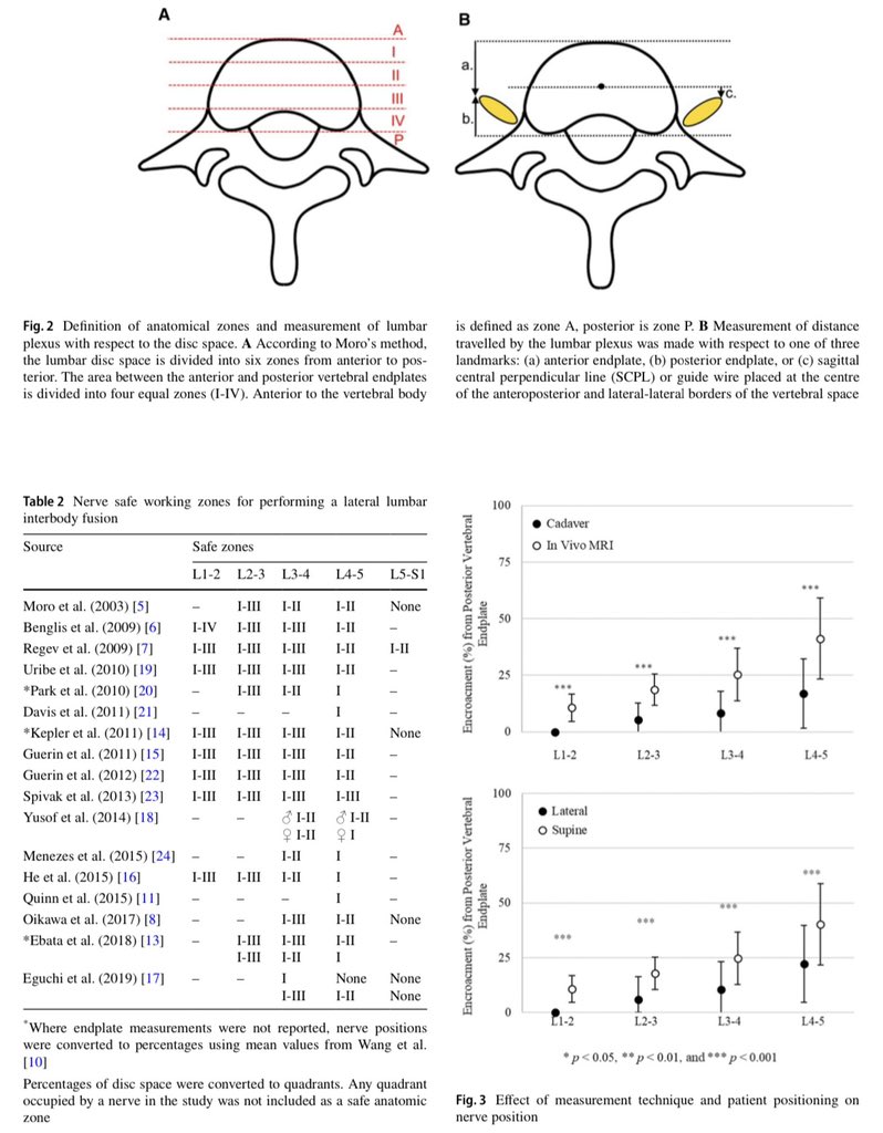 Check out this article about lumbar plexus safe working zones with lateral lumbar interbody fusion.
europeanspinejournal.org/article/101007…