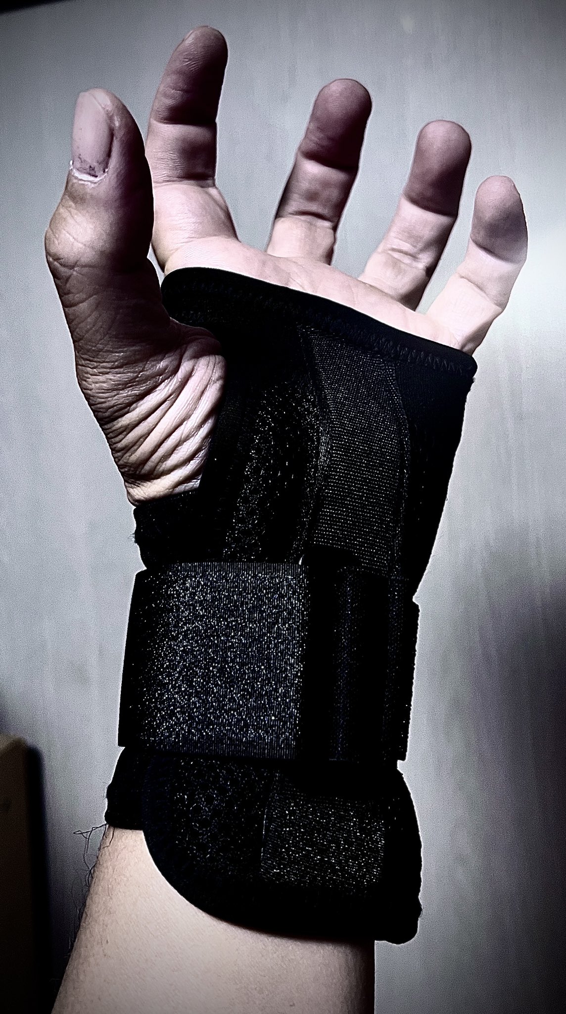 橈骨遠位端骨折 Twitter Search Twitter