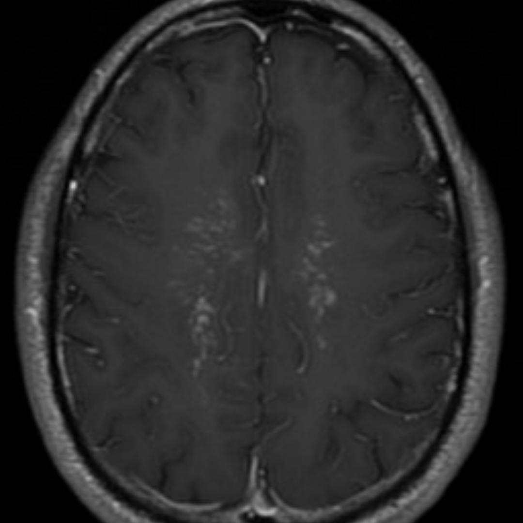 NeuroimagingN's tweet photo. Steroid-responsive brain inflammatory process

Reminiscence of CLIPPERS. Atypical location, as here, the pons didn´t have any abnormal signal.
Brain biopsy was negative for demyelination and it showed perivascular&amp;parenchymal lymphocytic infiltrates. 
GFAP ab negative.
#neurology https://t.co/ehRMPMHreI