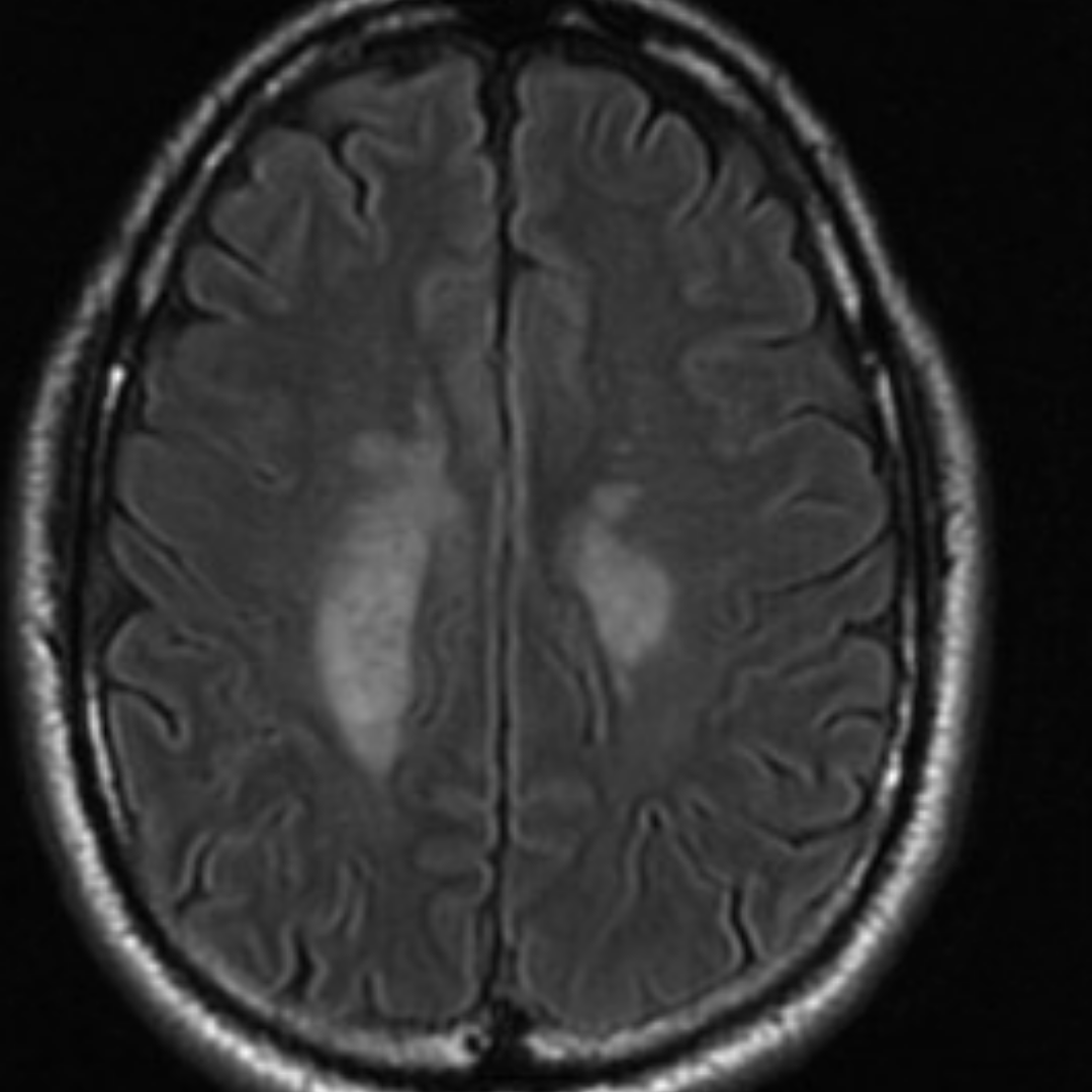 NeuroimagingN's tweet photo. Steroid-responsive brain inflammatory process

Reminiscence of CLIPPERS. Atypical location, as here, the pons didn´t have any abnormal signal.
Brain biopsy was negative for demyelination and it showed perivascular&amp;parenchymal lymphocytic infiltrates. 
GFAP ab negative.
#neurology https://t.co/ehRMPMHreI