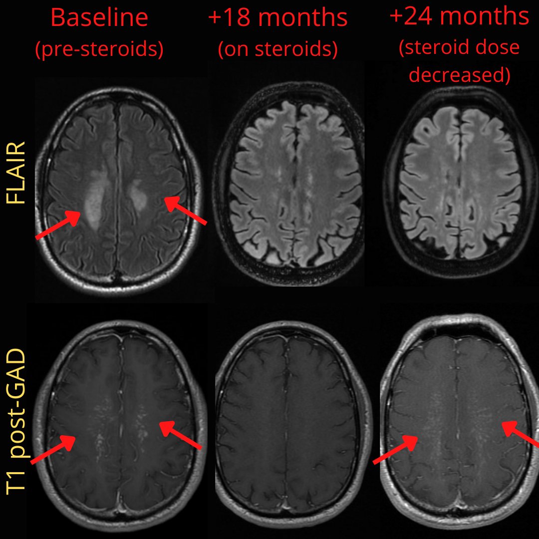 NeuroimagingN's tweet photo. Steroid-responsive brain inflammatory process

Reminiscence of CLIPPERS. Atypical location, as here, the pons didn´t have any abnormal signal.
Brain biopsy was negative for demyelination and it showed perivascular&amp;parenchymal lymphocytic infiltrates. 
GFAP ab negative.
#neurology https://t.co/ehRMPMHreI