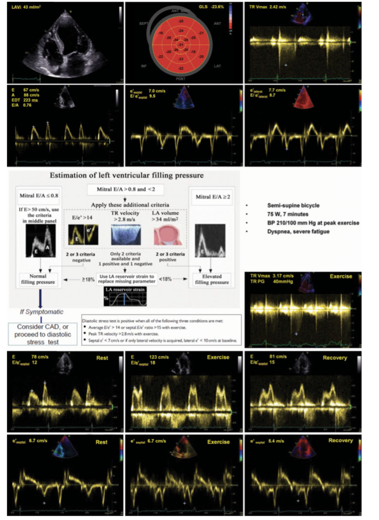 Emanuele Monda (@mondaemanuele) on Twitter photo How to assess left ventricular filling pressures by echocardiography in clinical practice
<a href="/escardio/">European Society of Cardiology</a> <a href="/ESC_Journals/">European Society of Cardiology Journals</a>
academic.oup.com/ehjcimaging/ar… How to assess left ventricular filling pressures by echocardiography in clinical practice
<a href="/escardio/">European Society of Cardiology</a> <a href="/ESC_Journals/">European Society of Cardiology Journals</a>
academic.oup.com/ehjcimaging/ar…