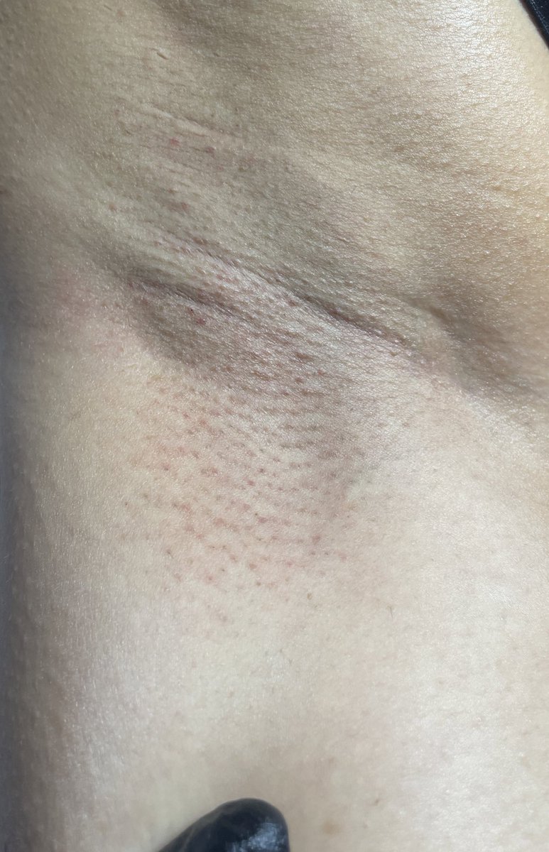 HoodSthetics's tweet photo. Underarm Wax

#Dallas #Skinwax https://t.co/yd0cbktjq4