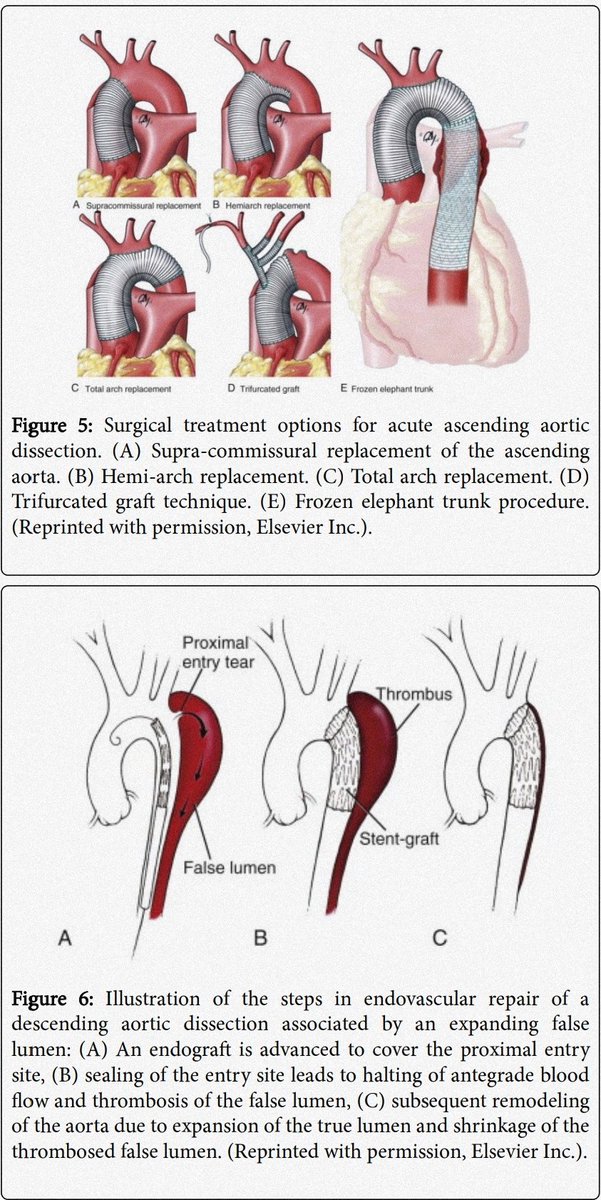 Grincircar's tweet photo. A Contemporary Review of Acute Aortic Dissection 
#SoMe4Surgery #Grincircar #Globalsurgery https://t.co/iX50WGN3Zr