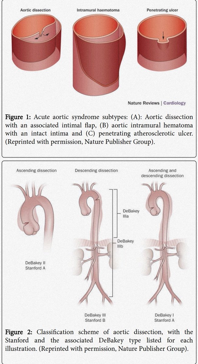 Grincircar's tweet photo. A Contemporary Review of Acute Aortic Dissection 
#SoMe4Surgery #Grincircar #Globalsurgery https://t.co/iX50WGN3Zr