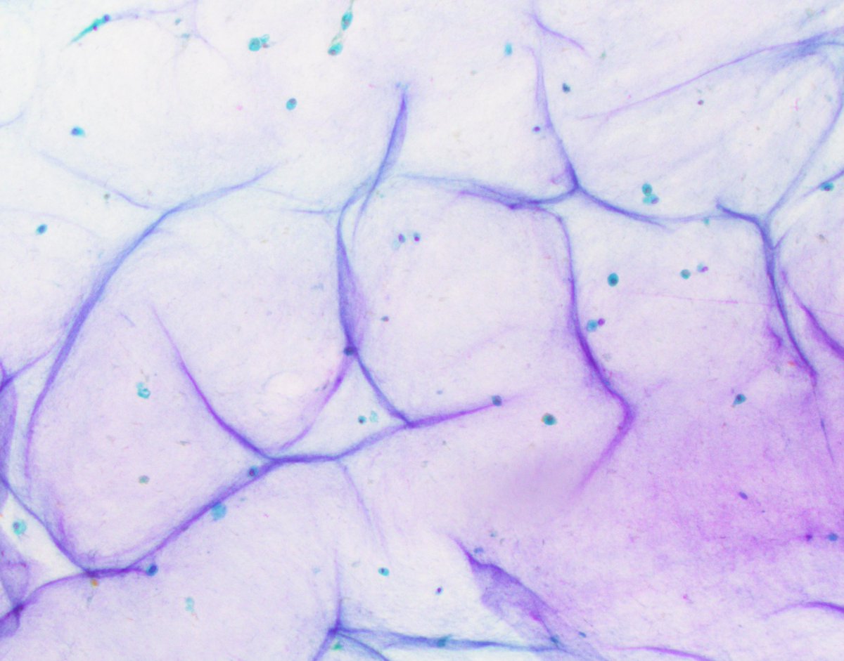 Classic case of a ganglion cyst, which shows scattered macrophages swimming in a sea of abundant myxoid material 

#CytoPath #PathTwitter #PathArt