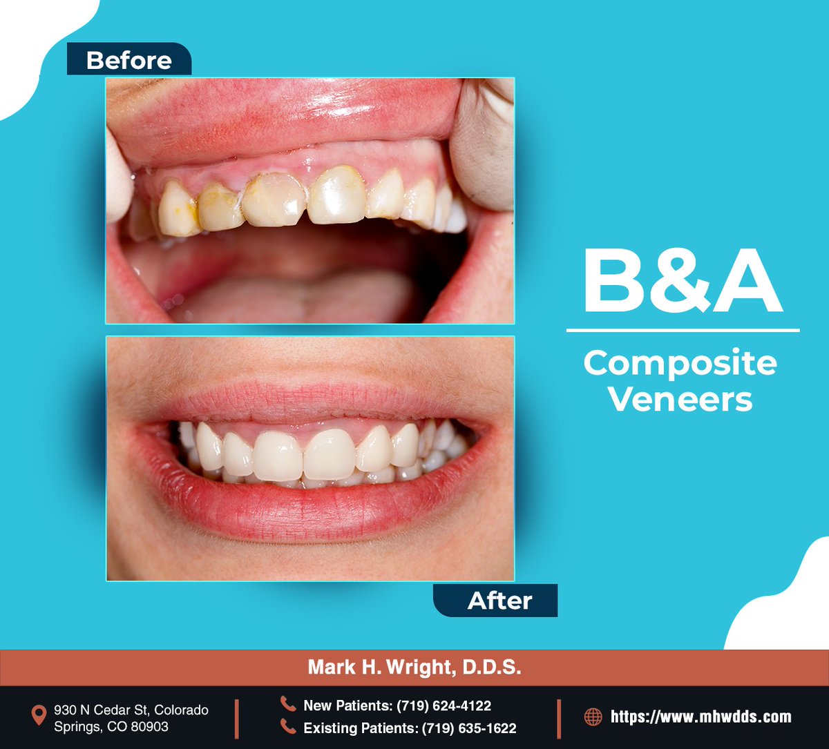 markhwrightdds's tweet photo. Dental veneers are an excellent option if you want to achieve a flawless smile like this one. See how veneers work to correct chips, gaps, stains, and more here: https://t.co/yrMNwD2sFG #veneersbeforeafter #stainedteeth #markhwrightdds #coloradosprings #CO https://t.co/0TsYAwMqIL