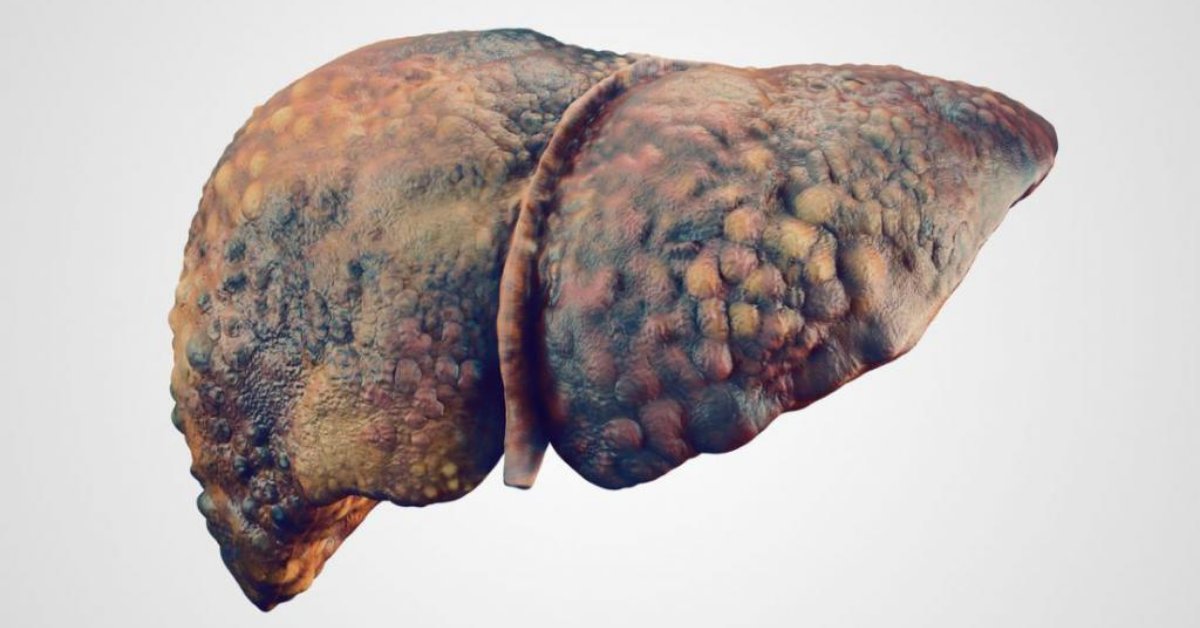 MDedge Hematology & Oncology (@mdedgehemonc) on Twitter photo #ICYMI THE NEW GASTROENTEROLOGIST's overview of therapeutic management of #NAFLD ms.spr.ly/6012jb7gI #ICYMI THE NEW GASTROENTEROLOGIST's overview of therapeutic management of #NAFLD ms.spr.ly/6012jb7gI