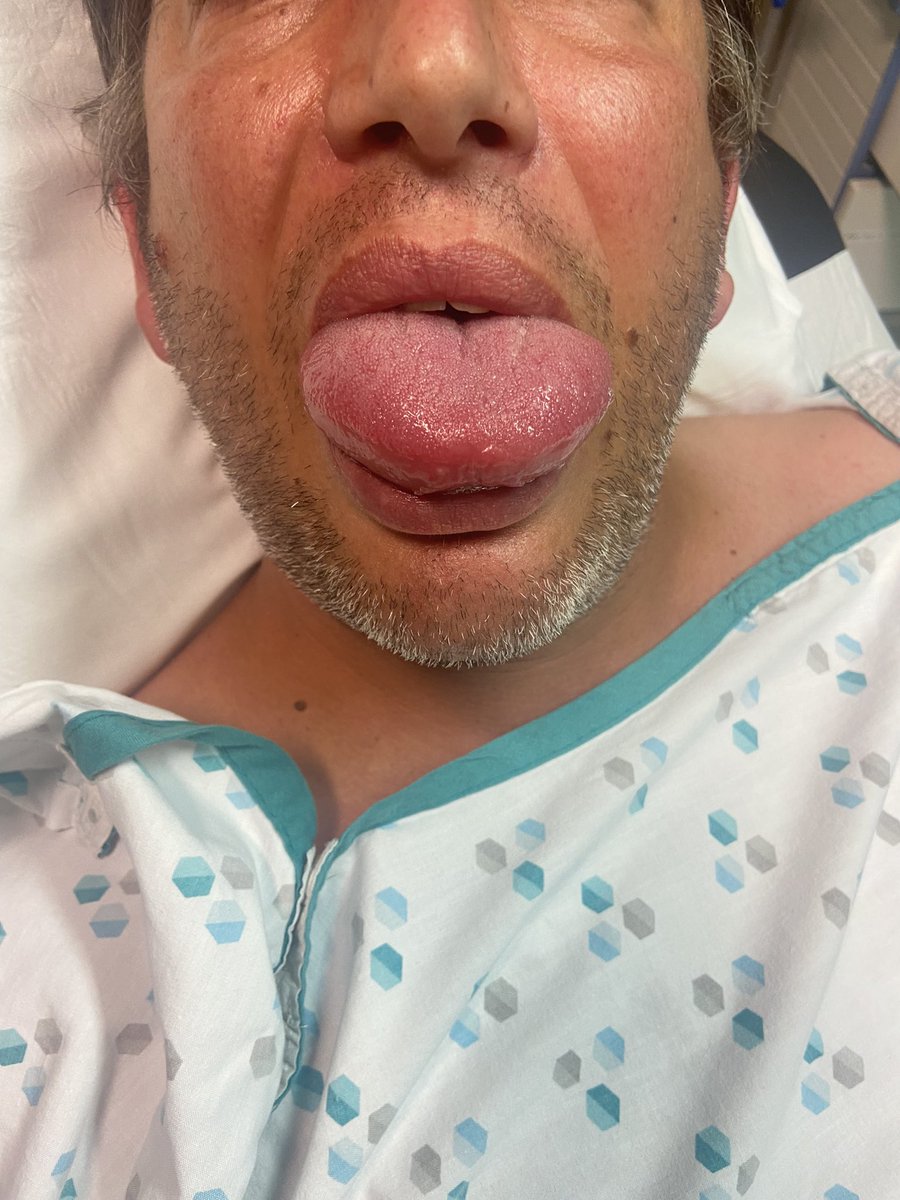 ward_devriese's tweet photo. Opgelet met #Wespen vrienden.
Best snel de spoed opzoeken.
Drink geen blikjes leeg die even onbewaakt buiten staan😉
Mijn oprechte dank aan spoed dienst @StLucasBrugge voor de goede zorgen https://t.co/v2jfpcMSfT