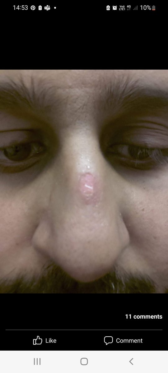 GhoshENTsurgeon's tweet photo. It is this photo 7 years ago on my last ever Laryngectomy as a consultant that reminds me why I now do nose!! FYI- didn't realise my loop lights were slowly cooking my rhinion. #surgeryfail #ENT https://t.co/9MxoGW9gBl