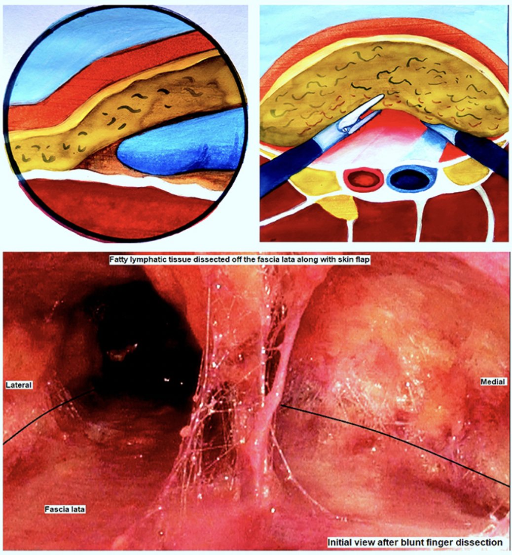 UroToday.com (@urotoday) on Twitter photo Modified video endoscopic inguinal lymphadenectomy: A deep first approach. #BeyondTheAbstract on UroToday > bit.ly/3AE7yBa <a href="/abhi07ap/">Dr. Abhishek Pandey</a> <a href="/PrasantNayak/">Prasant Nayak ๐ฎ๐ณ</a> <a href="/urogoldjournal/">Urology Gold Journal</a> Modified video endoscopic inguinal lymphadenectomy: A deep first approach. #BeyondTheAbstract on UroToday > bit.ly/3AE7yBa <a href="/abhi07ap/">Dr. Abhishek Pandey</a> <a href="/PrasantNayak/">Prasant Nayak ๐ฎ๐ณ</a> <a href="/urogoldjournal/">Urology Gold Journal</a>