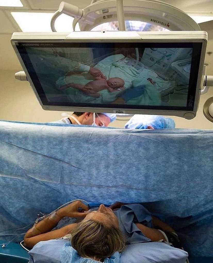 GenevieveCsneau's tweet image. How amazing would this be for our women who have a caesaran section or instrumental birth in theatre. It would mean they could be more involved with the initial top to toe assessment, watch mum/dad cut the last bit of cord, &amp;amp; observe resuscitation, if required. What do you think?