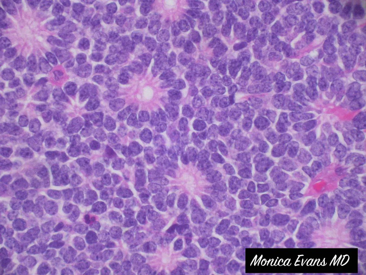 Jerad Gardner, MD (@jmgardnermd) on Twitter photo What are these classic ring-like structures? What tumor are they found in? Answer: kikoxp.com/posts/4321 #pathologists #pathology #pathTwitter #medstudents #MedStudentTwitter #USMLE #MedTwitter <a href="/DGlaucomflecken/">Dr. Glaucomflecken</a> What are these classic ring-like structures? What tumor are they found in? Answer: kikoxp.com/posts/4321 #pathologists #pathology #pathTwitter #medstudents #MedStudentTwitter #USMLE #MedTwitter <a href="/DGlaucomflecken/">Dr. Glaucomflecken</a>