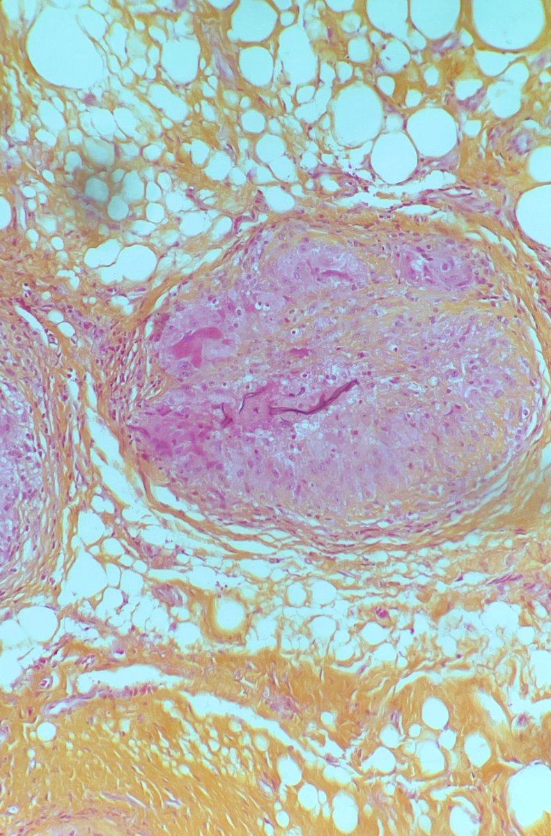 granulome_'s tweet photo. Mucormycosis or black fungus.              Curretage of the maxillary sinus.          No context. #PathTwitter #pathbug https://t.co/HqHbTssBVW