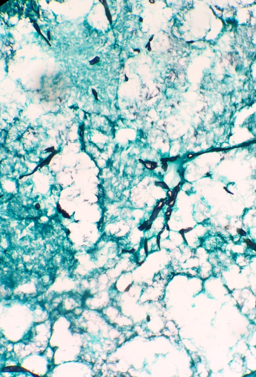 granulome_'s tweet photo. Mucormycosis or black fungus.              Curretage of the maxillary sinus.          No context. #PathTwitter #pathbug https://t.co/HqHbTssBVW