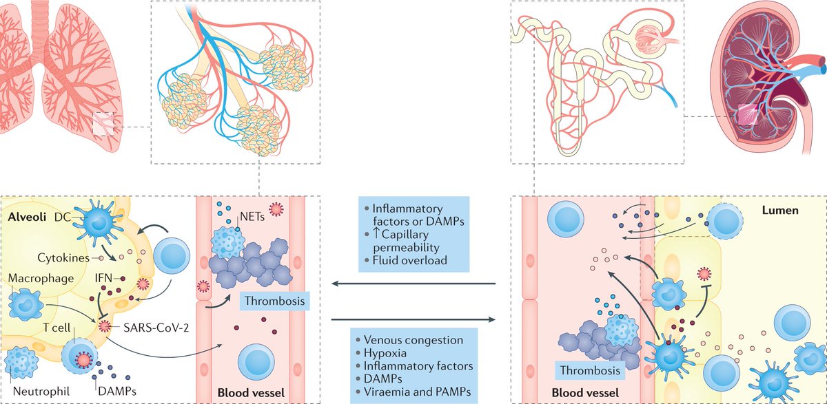 NatRevNeph's tweet photo. Shared pathophysiology between lung and kidney injury in COVID-19 https://t.co/VwudntSgw3 https://t.co/HlwgyKqWBn
